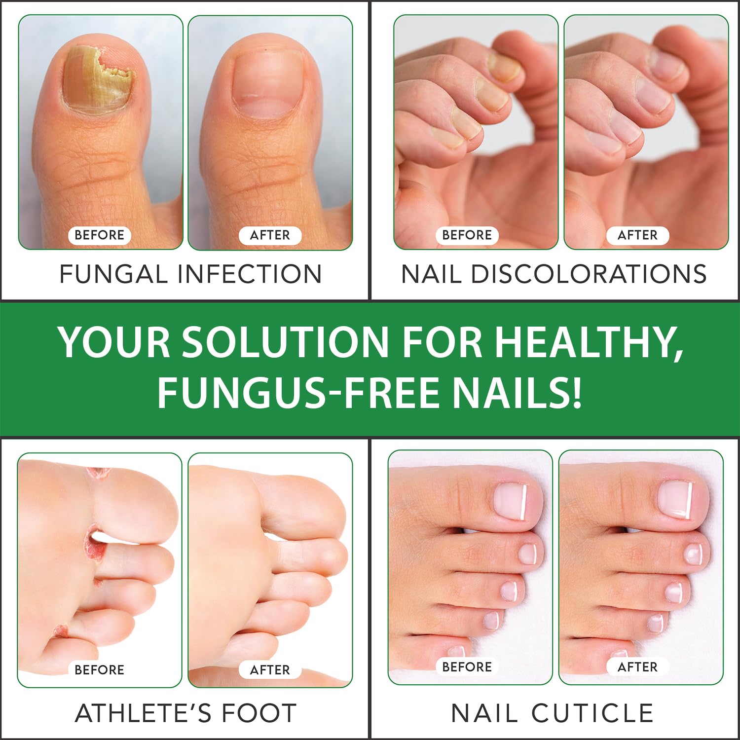 Four images demonstrating the transformative power of Toenail Fungus Treatment Extra Strength with 1% Tolnaftate OTC, highlighting impressive before and after results in treating fungal infections and discolored nails.